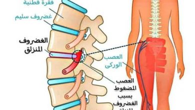 عرق النسا