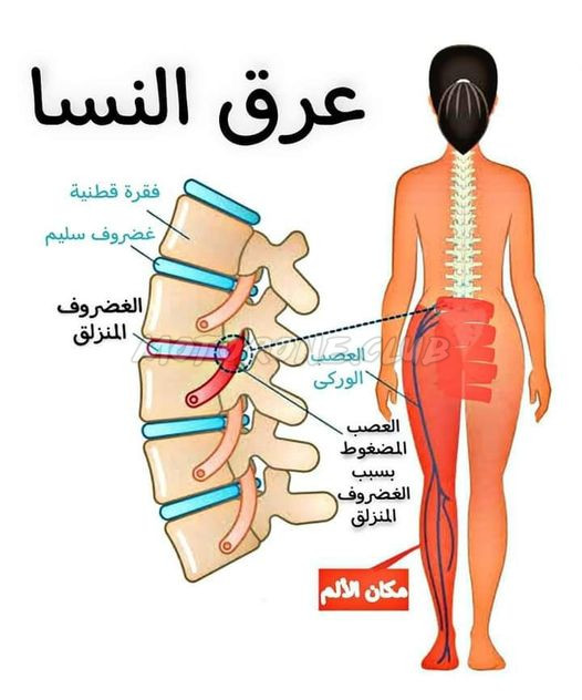 عرق النسا