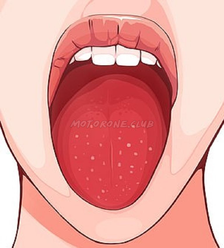 نقص البوتاسيوم