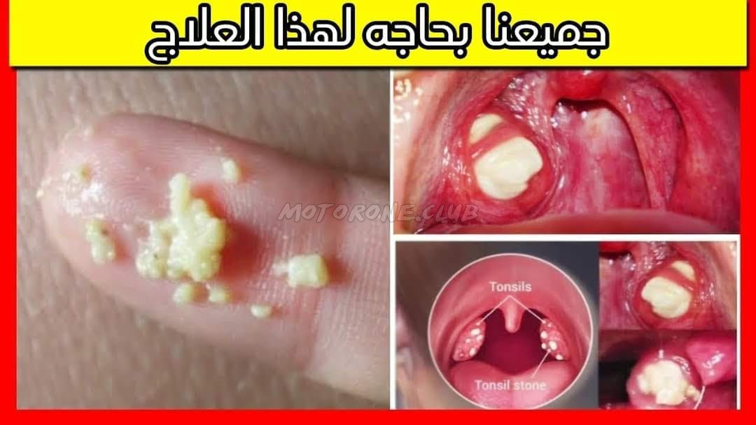 القضاء على رائحة الفم الكريهة