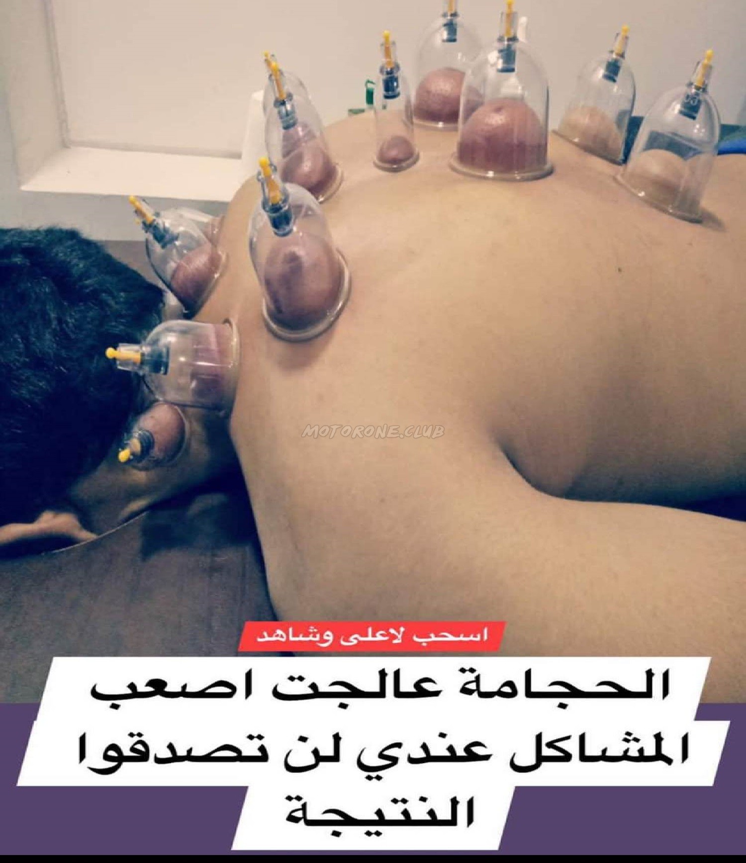 فوائد الحجامة